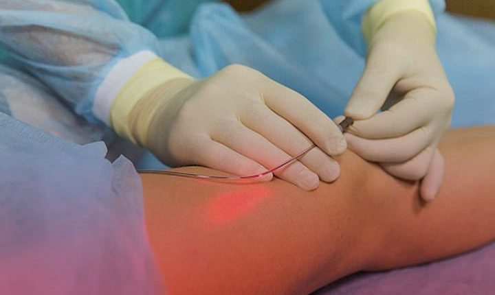 عمل کیست مویی مقعد با لیزر