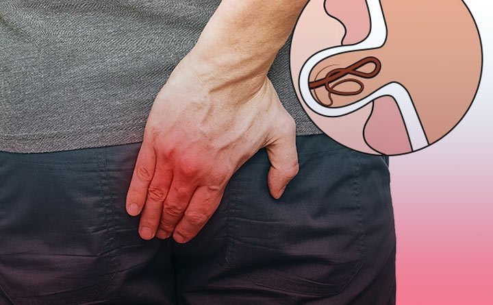 کیست مویی مقعدی